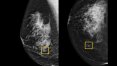 Study finds Google system could improve breast cancer detection