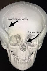 A 3D image of Charlie's skull after he was bitten by a dog.