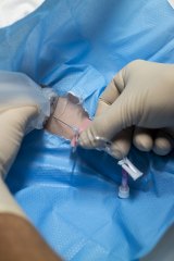 More than half of all the patients admitted to hospital will need an intravenous catheter.