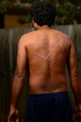 Tamil aslyum seeker 'Kumar' shows his wounds.