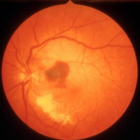 Macular dystrophy is a genetic disorder of the eye which people get young.