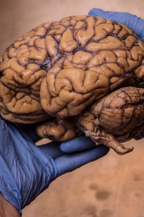 A donated brain at Sydney University.