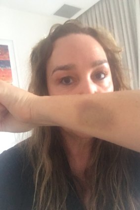 Kate Langbroek's arm was bruised in the attack.