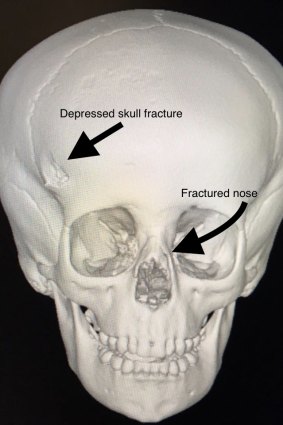 A 3D image of Charlie's skull after he was bitten by a dog.