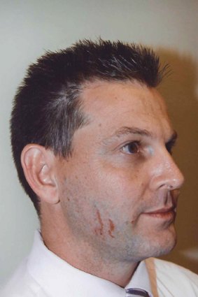 Police photograph of marks on Gerard Baden-Clay's face.