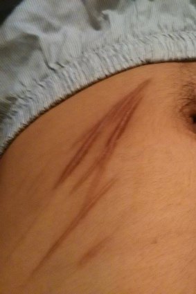 Scars on the torso of Mohammad Albederee, who has been cutting himself with a razor.