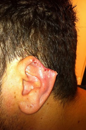 This Canberra man lost part of his ear after it was bitten in a Dickson nightspot.