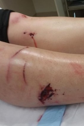 Michaela Vodvarka required 10 stitches after she was bitten by a wild pig.