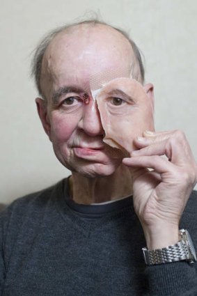 Eric Moger has a partial prosthetic face after suffering from face cancer.