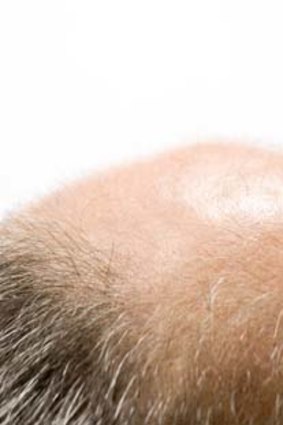 Hair there, gone tomorrow ... balding is an inescapable fact for some.