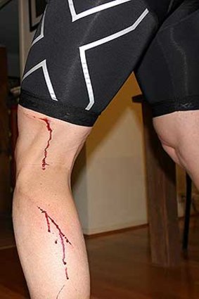 Shane Rattenbury's leg after the run-in with a kangaroo.