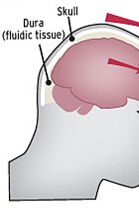 Mind over matter ... an external blow causes concussion, which is a mild form of brain trauma.