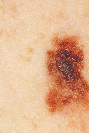 A typical melanoma.