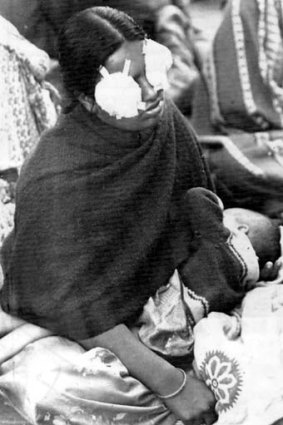 A woman blinded by the toxic gas just days after the disaster in December 1984.