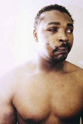 This photo of Rodney King was taken three days after his videotaped beating in Los Angeles on March 6, 1991.