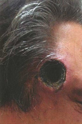 Black salve's dangers are evident in this picture. A hole is clearly visible in the side of the subject's head.