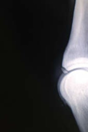 Joint problem: An x-ray of a fetlock chip.