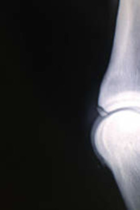 Joint problem: An x-ray of a fetlock chip.