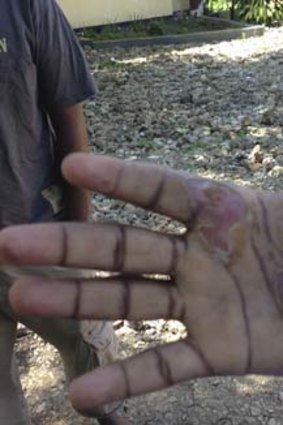 An asylum seeker claims he was deliberately burned.