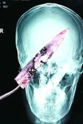 Splitting headache ... an X-ray reveals the blade in Mr Li’s skull.