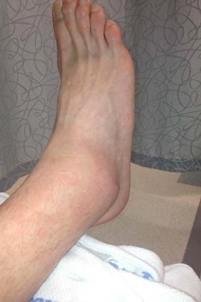 Ugly ... Nash Rawiller tweeted this image of his ankle on Tuesday.