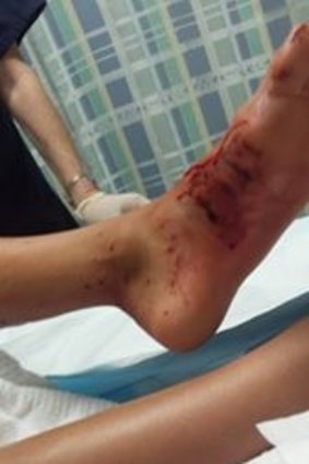 Kirra-belle Olsson, who was bitten by a shark, shows her injuries in Gosford Hospital