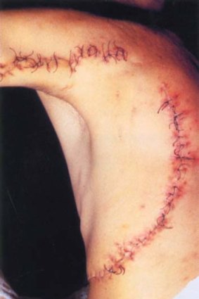 Stitched up: Rodney Fox's stiched torso after the near-fatal attack 50 years ago.
