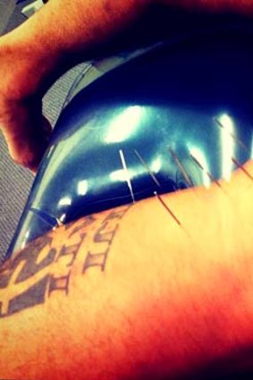 Prickly customer  ... Injured Eel Jarryd Hayne gets stuck in at an acupuncture session yesterday.