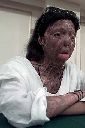 Fakhra Younus after the acid attack.