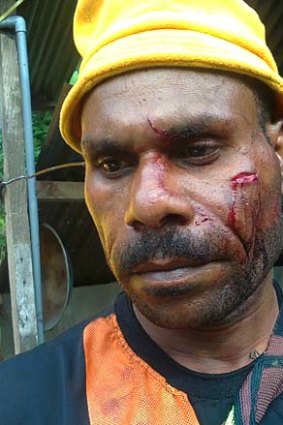 A West Papuan man with facial injuries.