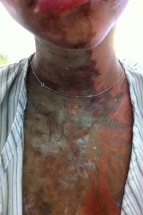 A photo of one of two British teenagers injured in an acid attack in Zanzibar. The unidentified image was released by the victims' families.