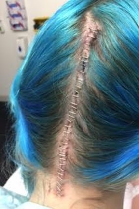 Canberra teenager Asha Miller after major brain surgery last year to help address the neurological disorder Chiari Malformation. The surgery did not require her to have her head shaved, so she dyed her hair blue for the occasion. She had 34 staples as a result of the surgery.