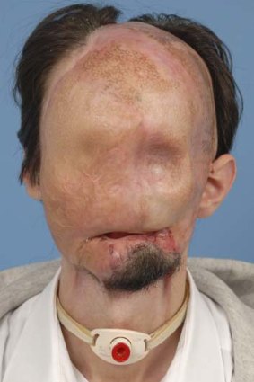 Dallas Wiens, prior to receiving a full face transplant