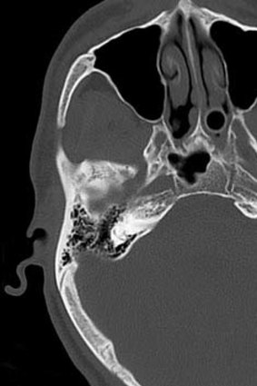 A CT scan shows the skull fracture where Mr Cramp's head hit the pavement.