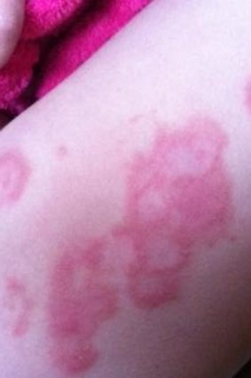 The ulcers on the child's thigh.