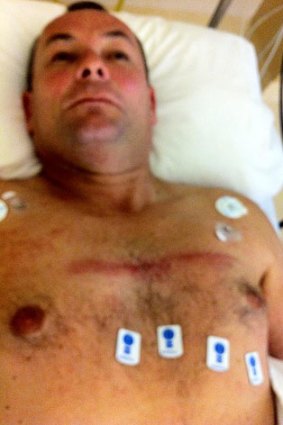 Bruising on First Class Constable Declan Kelly’s chest marks where he was hit by the car door, which pinned him to a light pole. <i>Photo: Police Media</i>