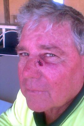 Battle scars ... president of the Bowen Turf Club Cyril Vains was allegedly struck by ALP candidate for Dawson, Mike Brunker.