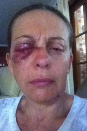 "I had to sit down, trying not to faint.": Sydney woman Angela suffered a serious eye injury after being attacked by two dogs.