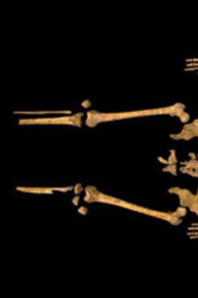 The remains of Richard III show a marked curvature of the spine.