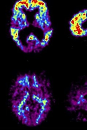 Scans of Alzheimer's sufferer brain.