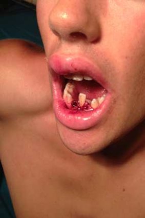 This 16-year-old boy was allegedly punched in the face at a party in Narrabundah on Monday night.