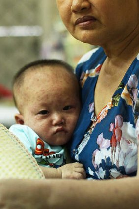 A boy suffering from measles is held by his grandmother.