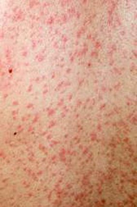 Measles causes fever, cough and a runny nose, then a red spotty rash and sore eyes.