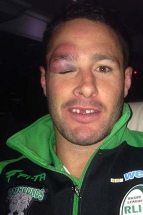 Brett White nursing a bruised eye from the clash with England.