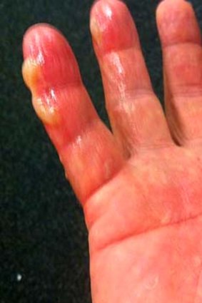 The image placed on Shane Warne's Twitter site, supposedly showing his burnt bowling hand.