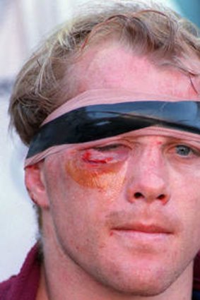 Toovey sporting a few cuts under the eye in 1996.