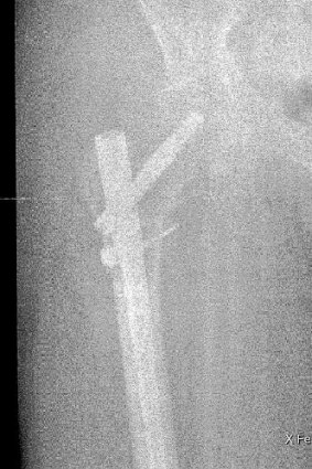 A detail from an X-ray following surgery to repair Mr Cowled's shattered femur.