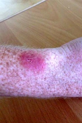 Another user's skin irritation after using Fitbit Force.