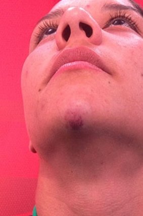 Bruised: Sam Kerr after the incident.