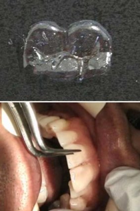 The ultra thin biocompatible film (top) and the tooth-patch being applied (bottom) onto a man's front teeth at a laboratory in Kinokawa in western Japan.